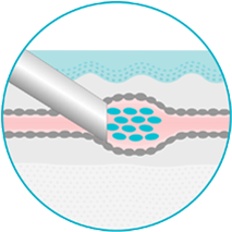 Escleroterapia